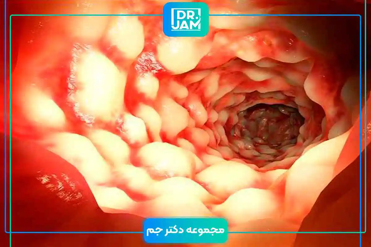 Ulcerative colitis