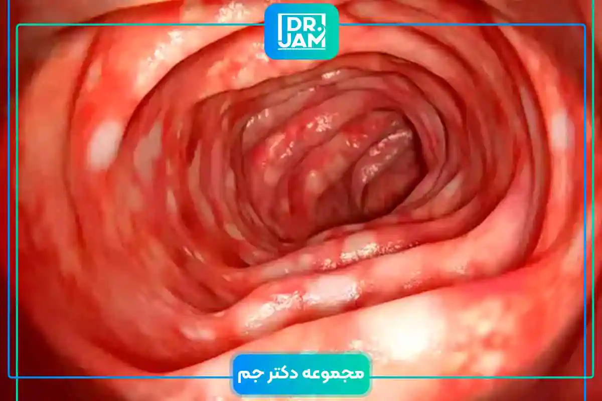 Ulcerative Colitis