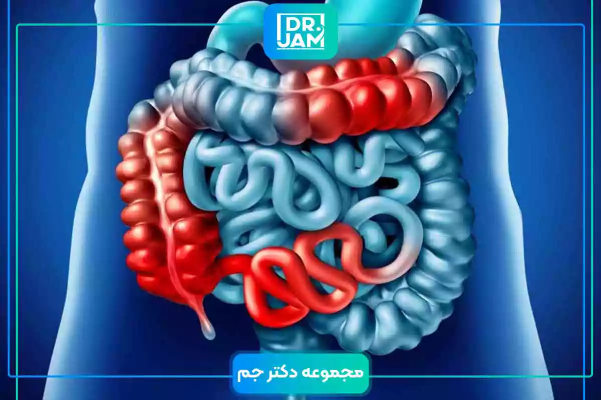 What is crohn's disease?
