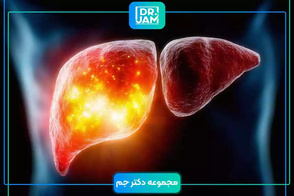 What is the relation between NAFLD and psoriasis