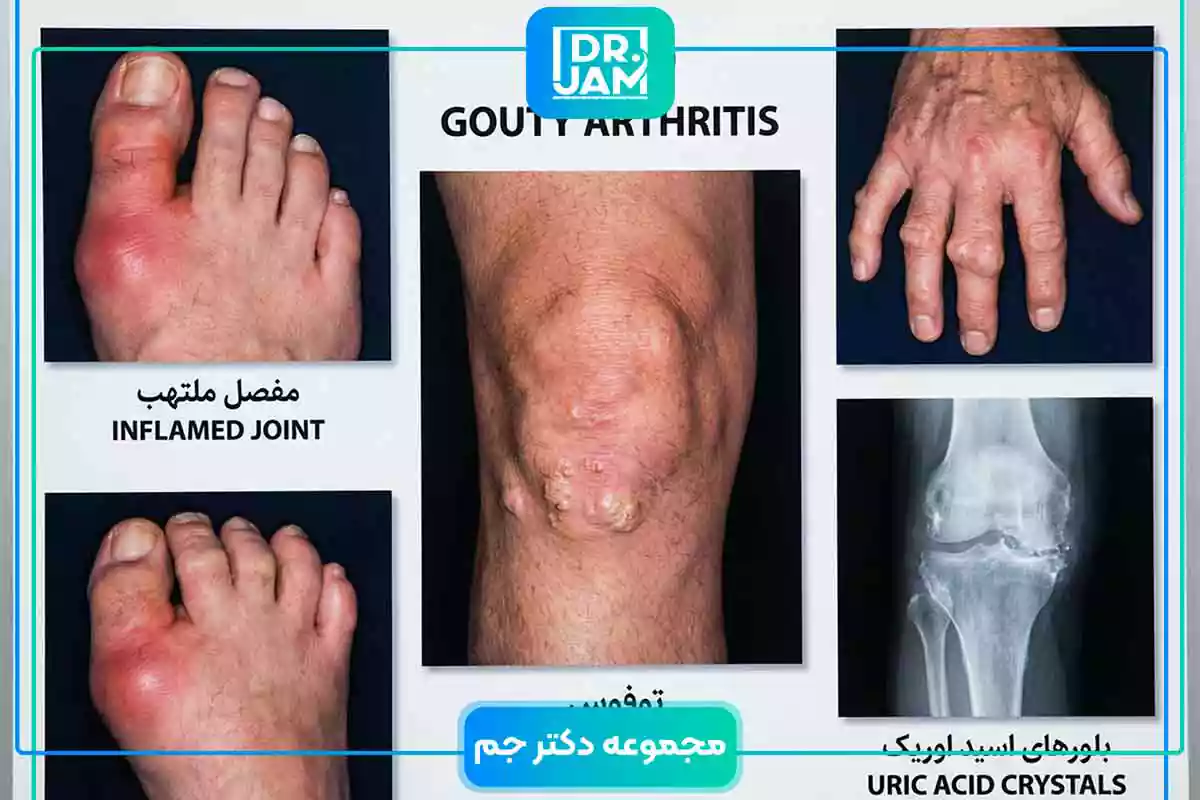Gout