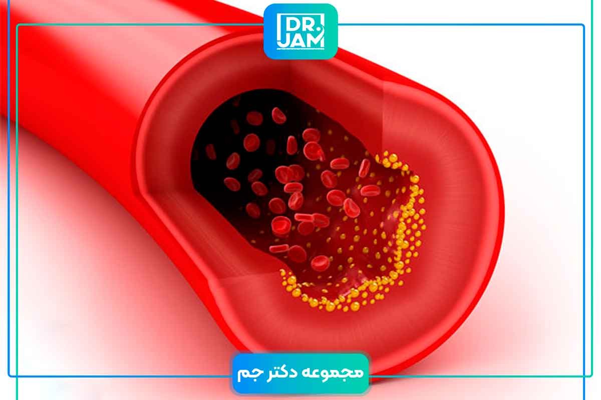 What are the sign and symptoms of high lipid profile