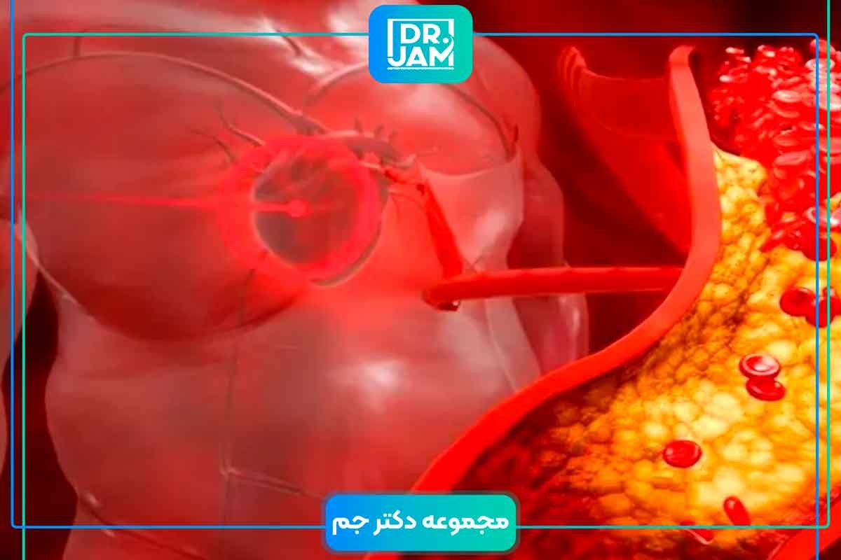 High lipid profile symptoms