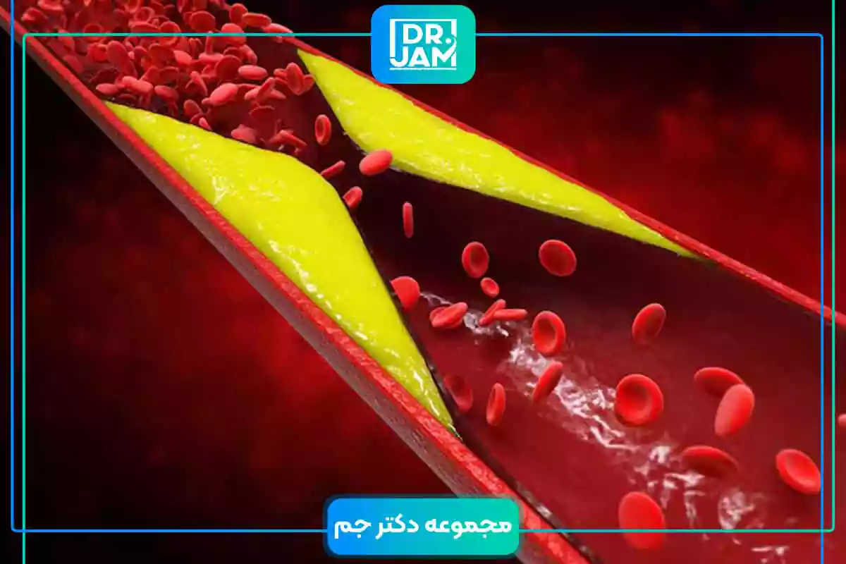 High cholesterol levels