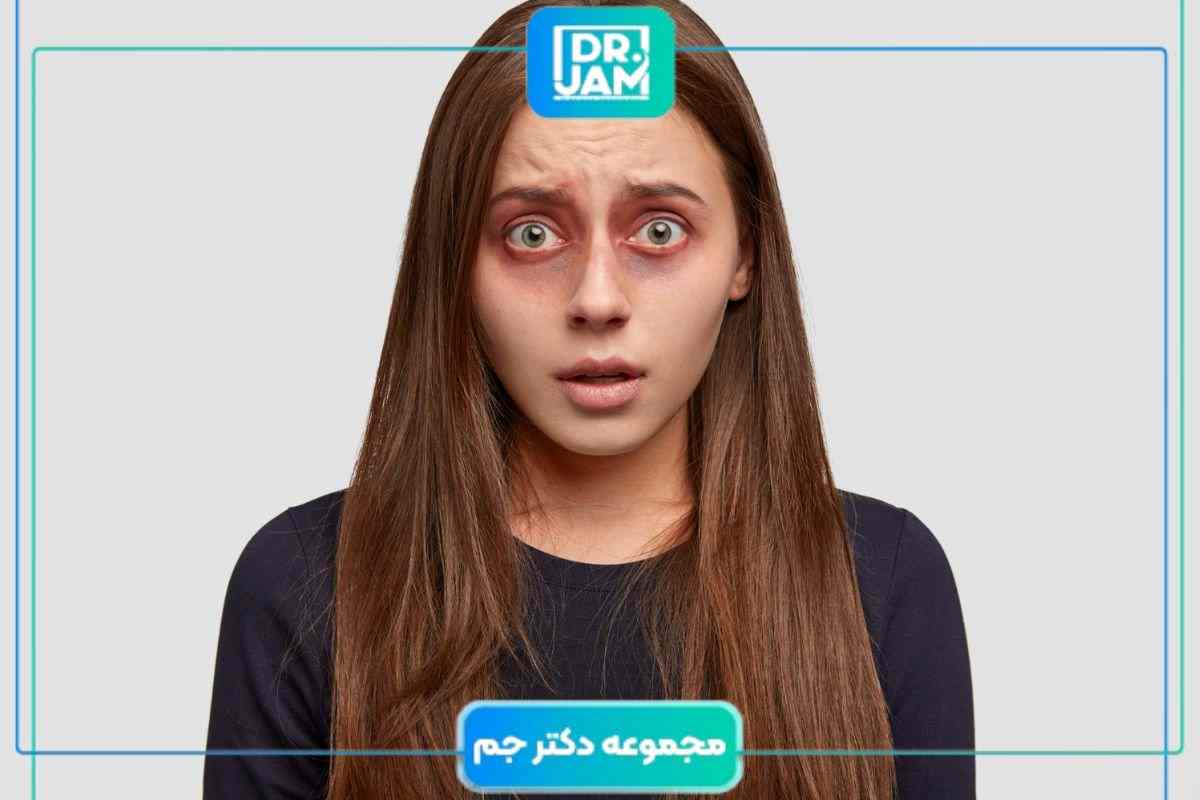 تیرگی دور چشم؛ علت واقعی ایجاد آن و مؤثرترین روش‌های درمان