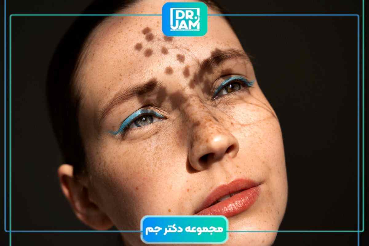 درمان بدون بازگشت لک بارداری یا ملاسما